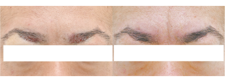 眉毛植毛100Gの症例写真 治療前と治療6ヶ月後の比較