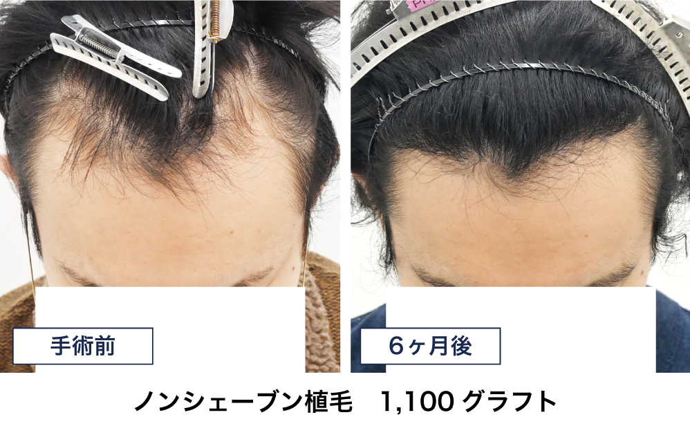 20代 1100グラフトの自毛植毛