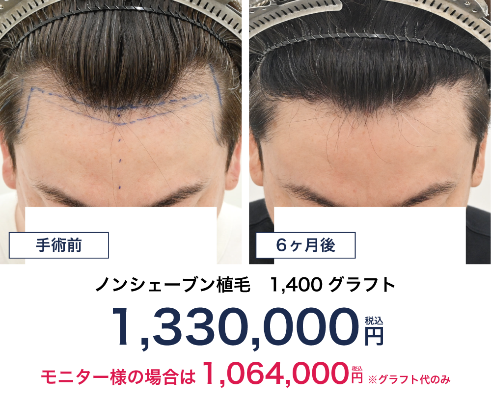 40代 1400グラフトの自毛植毛