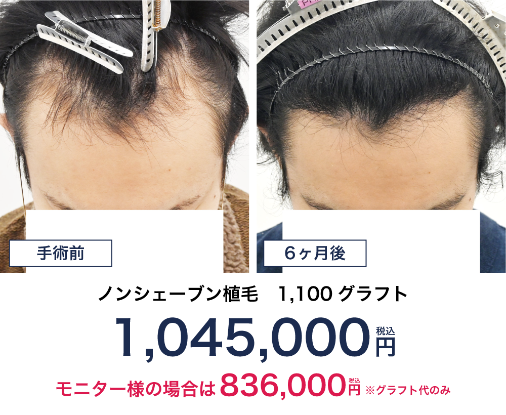 20代 1100グラフトの自毛植毛