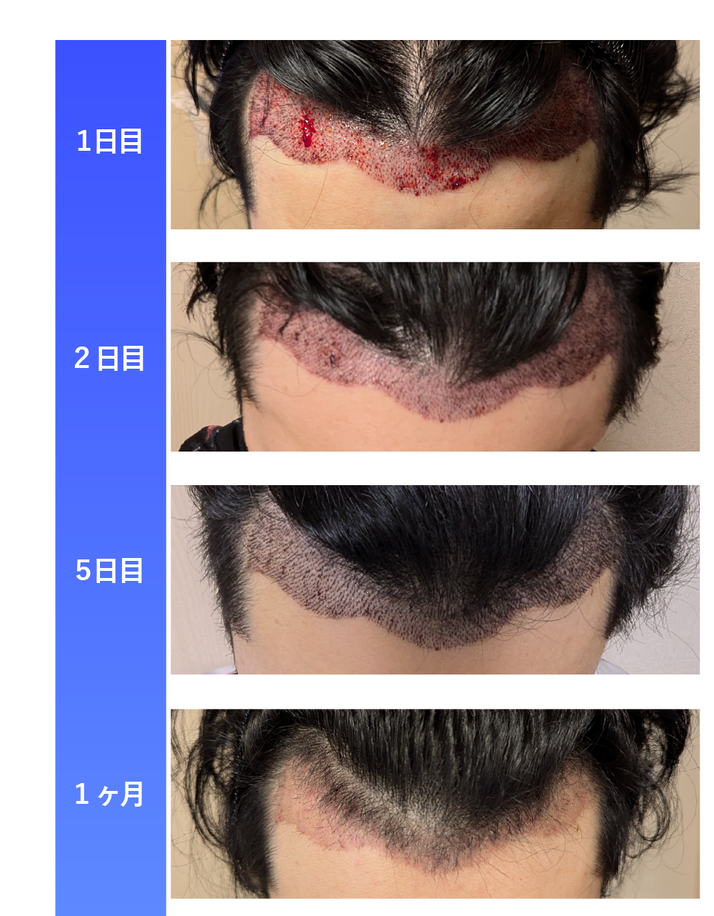 写真】自毛植毛の経過を解説！1日目～5ヶ月目まで - 湘南AGAクリニック福岡院-AGA治療・薄毛治療・自毛植毛