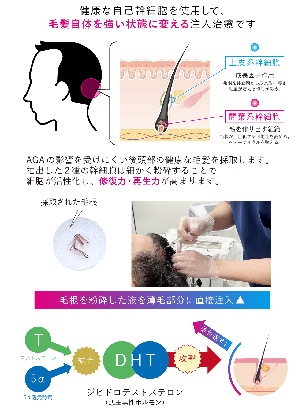 毛根再生注射の仕組み