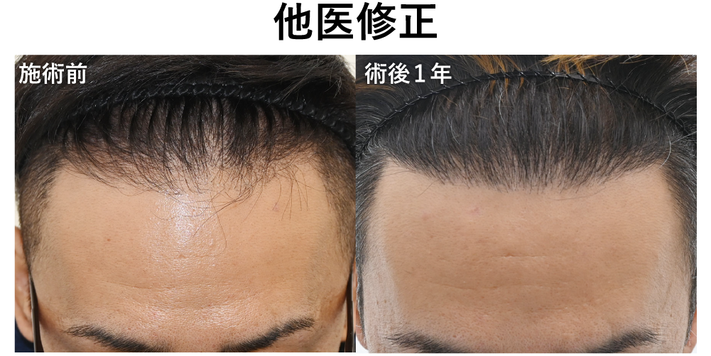 40代男性の修正植毛手術