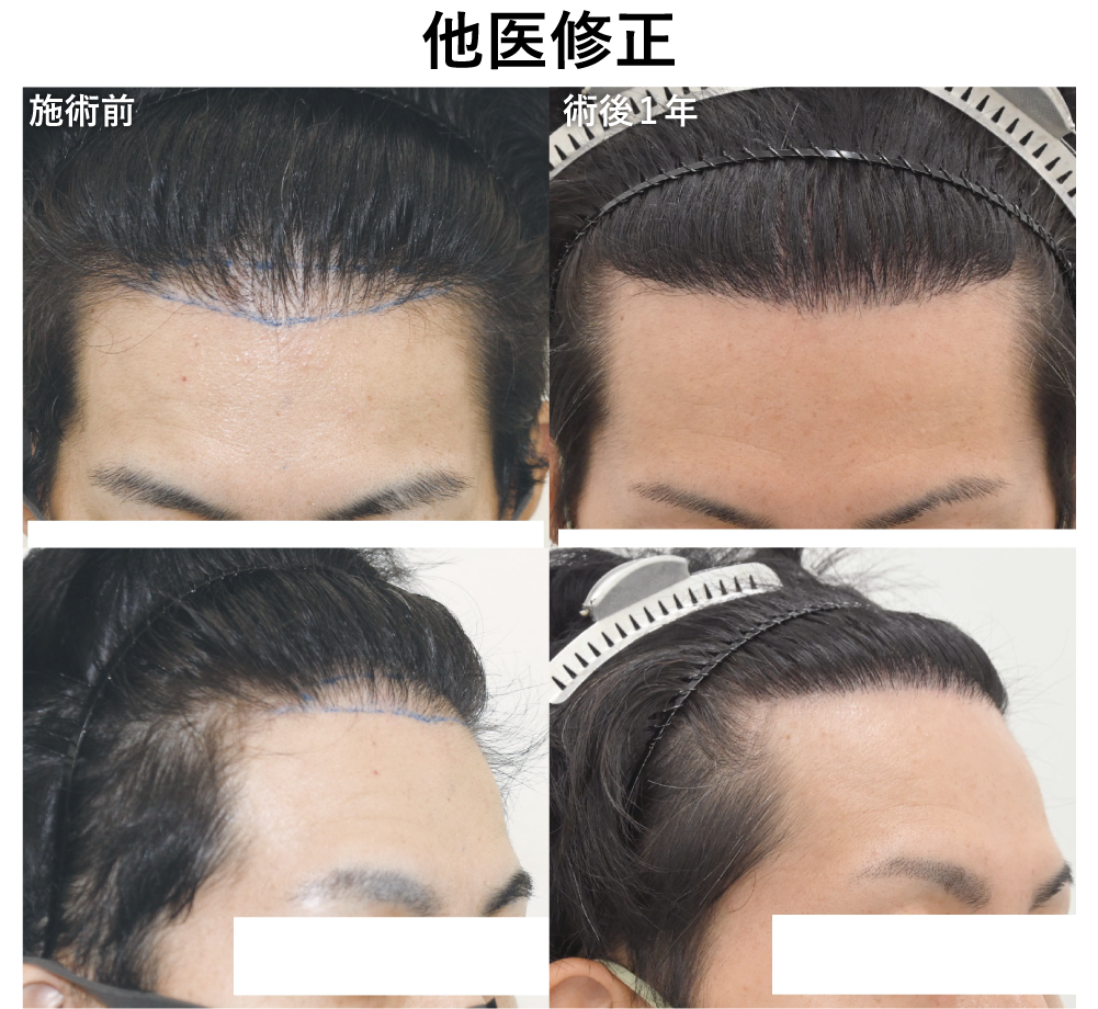 30代男性の修正植毛手術