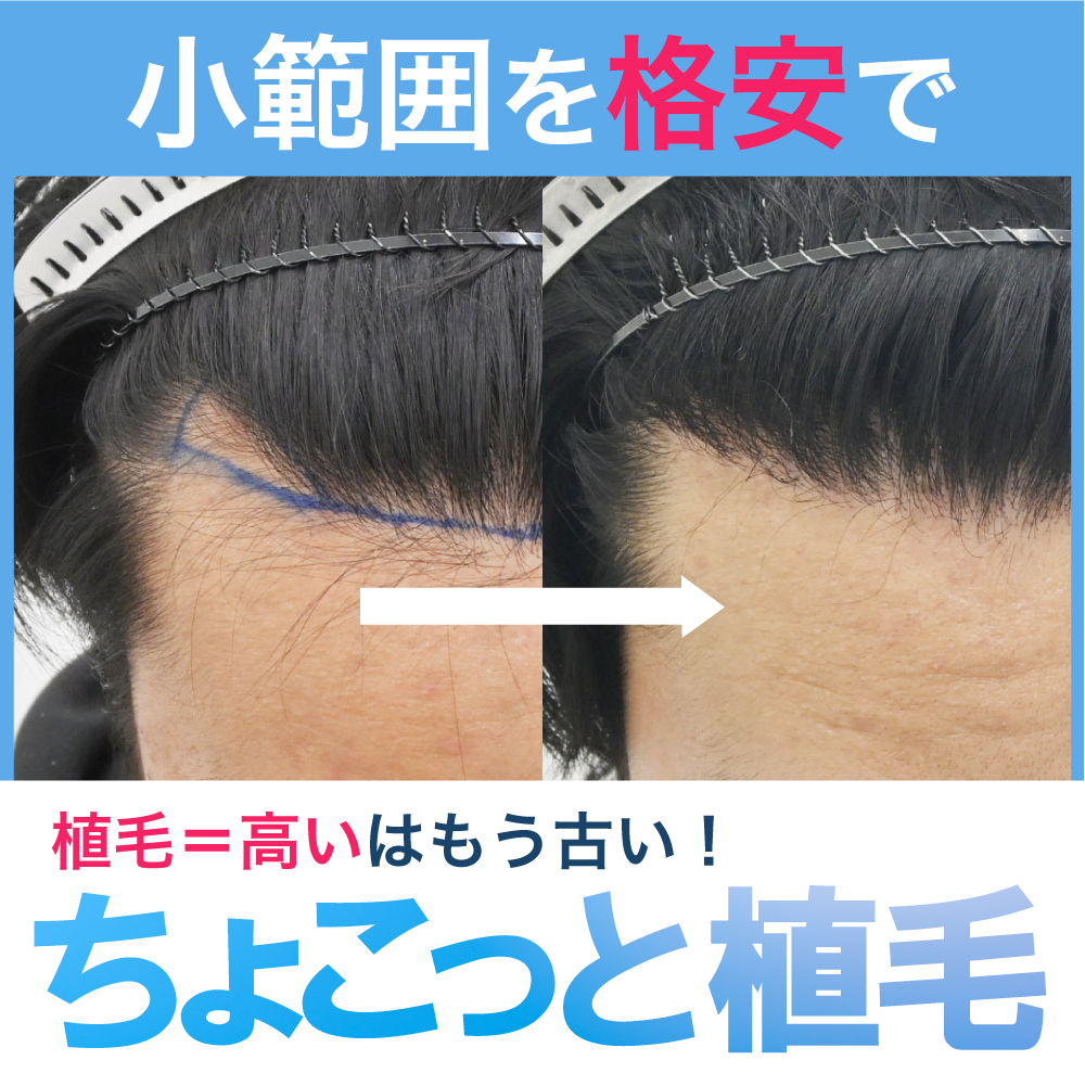 シリコーン製 ヘッド単品:髪の毛と眉毛と睫毛植毛式口可動MYDF 