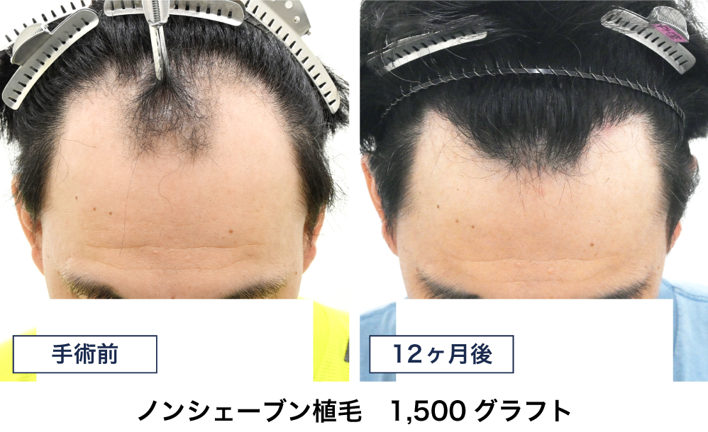 30代 1500グラフトの自毛植毛