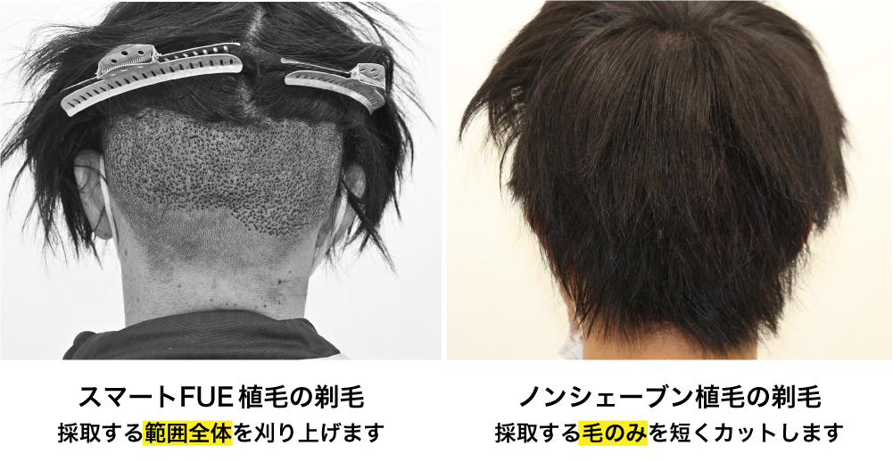 スマートFUE植毛とノンシェーブン植毛の違い