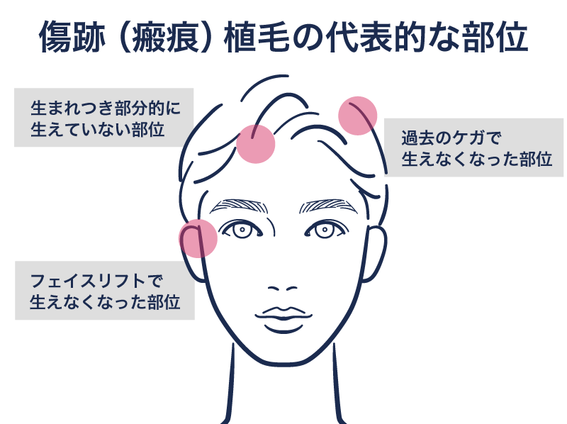 傷跡の自毛植毛のご相談例