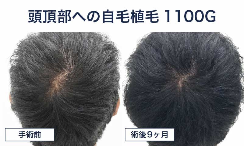 20代男性 自毛植毛1100グラフト