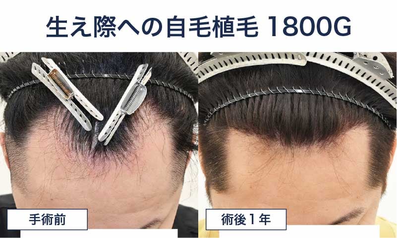 30代男性 自毛植毛1800グラフト