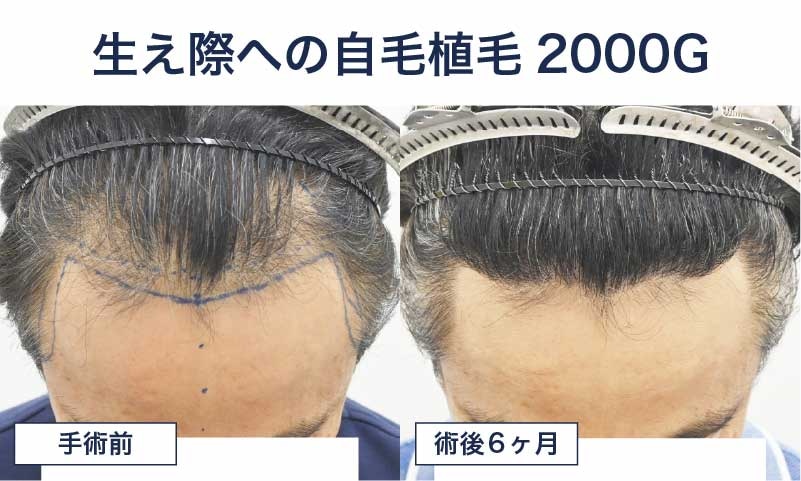 50代男性 自毛植毛2000グラフト