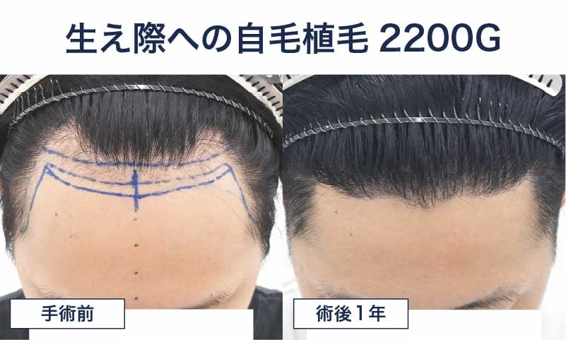 20代男性 自毛植毛2200グラフト
