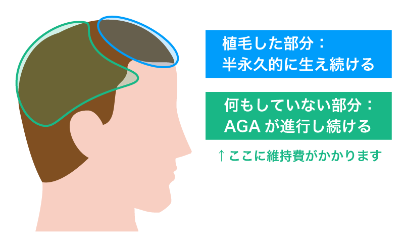 維持費がかかるのは「既存毛」