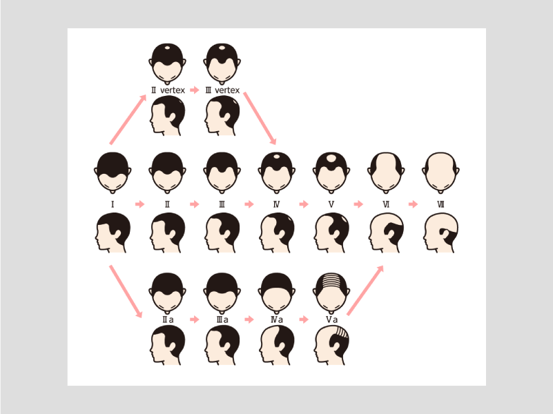 AGAの進行度によって変わります