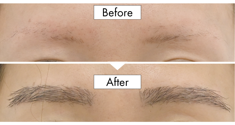 特別編④眉毛への自毛植毛