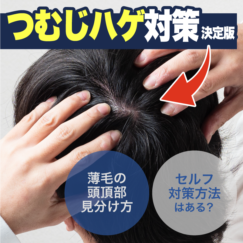 つむじはげ対策の決定版！自力で治る？確実な改善方法は？