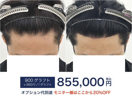 自毛植毛900Gの症例写真 治療前と治療6ヶ月後の比較