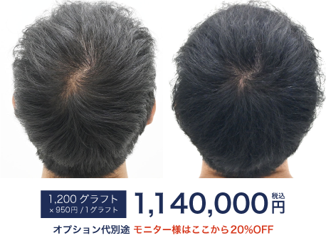 自毛植毛1200Gの症例写真 治療前と治療9ヶ月後の比較