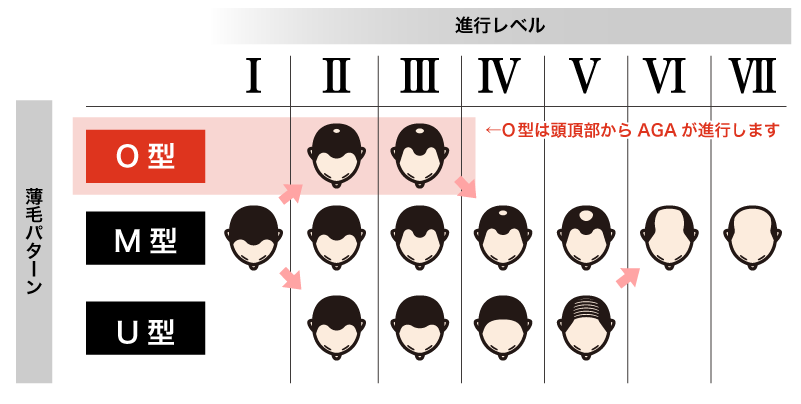 なぜつむじからハゲる?