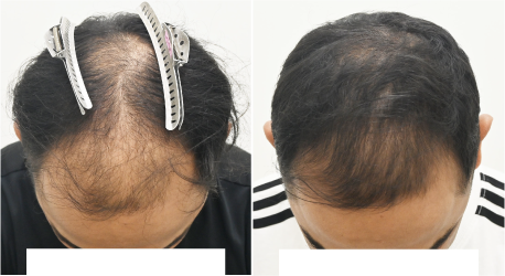 毛根再生注射の症例写真 治療前と治療3ヶ月後の比較