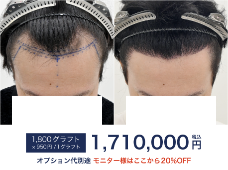 自毛植毛1800Gの症例写真 治療前と治療12ヶ月後の比較