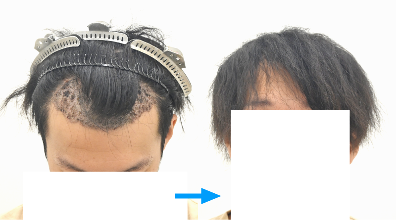 移植部：前髪で隠せばバレにくい