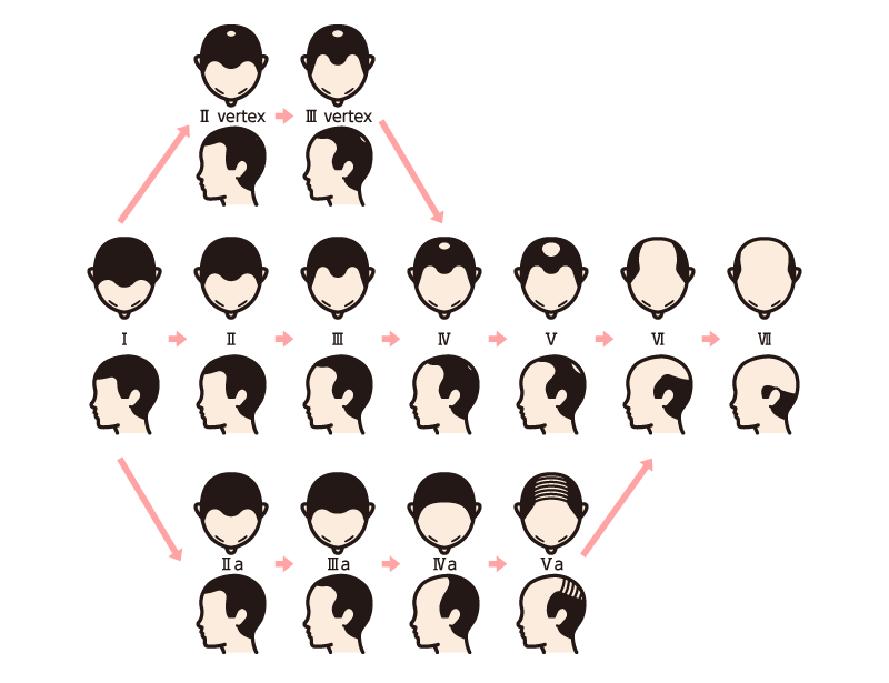 AGAが進行しすぎている