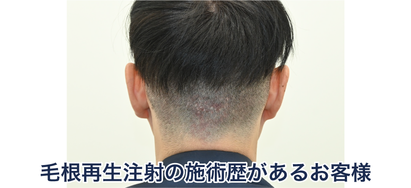 採取された毛根は2度と生えてこない