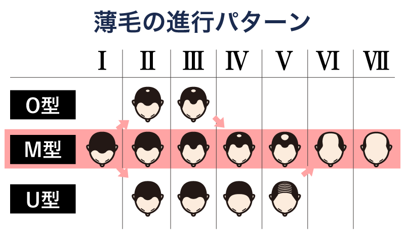 「M字からハゲる」薄毛進行パターンがある
