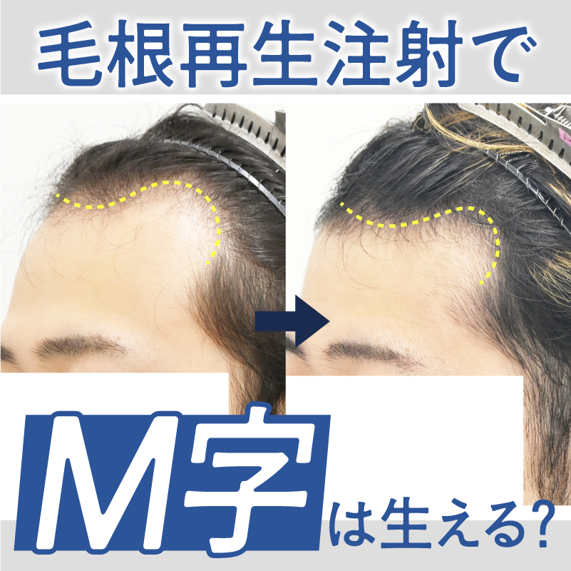 生え際・M字に毛根再生注射は効果ある？仕組みや症例、効かないケースとは