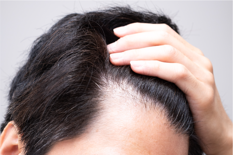 すでに毛根が死滅していると改善は難しい