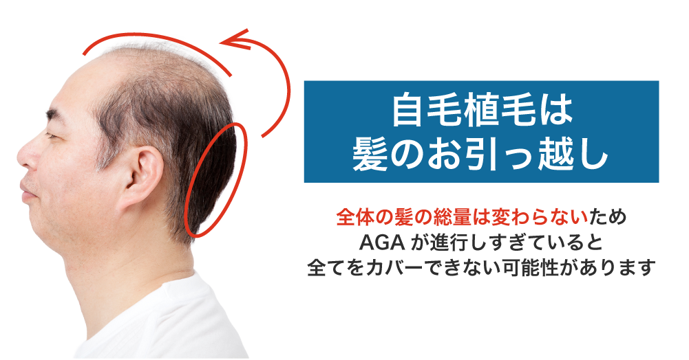 自毛植毛は「髪の毛のお引越し」