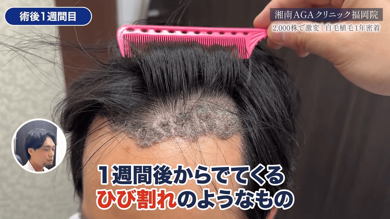 術後1週間目:移植部にひび割れが?!