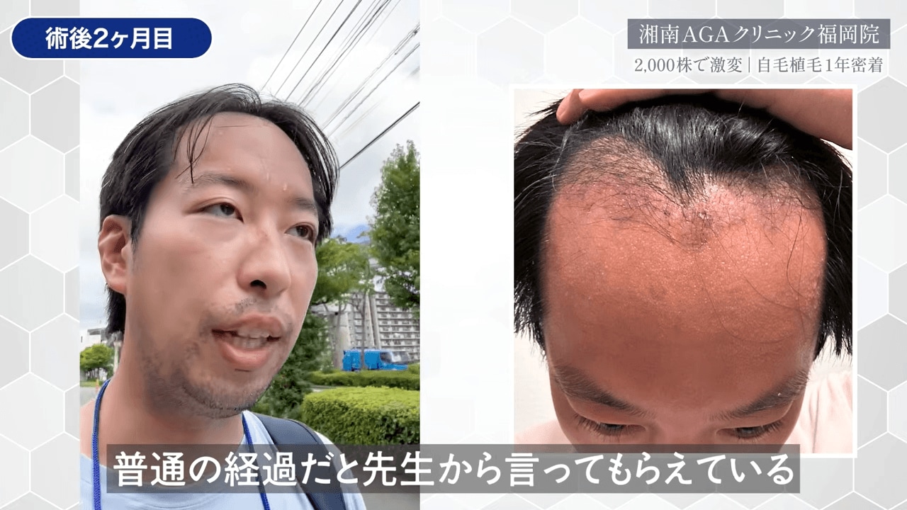 術後2ヶ月目:移植毛の脱落