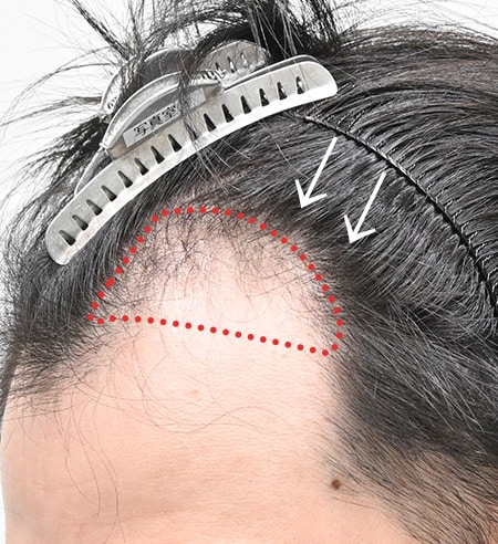 主訴：ヘアライン一番手前に持っていきたい