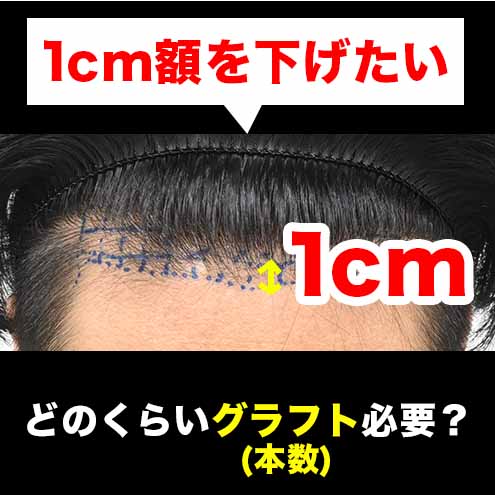 【自毛植毛の真実】額を1cm狭めるのに必要なグラフト数と実際の症例を徹底解説！