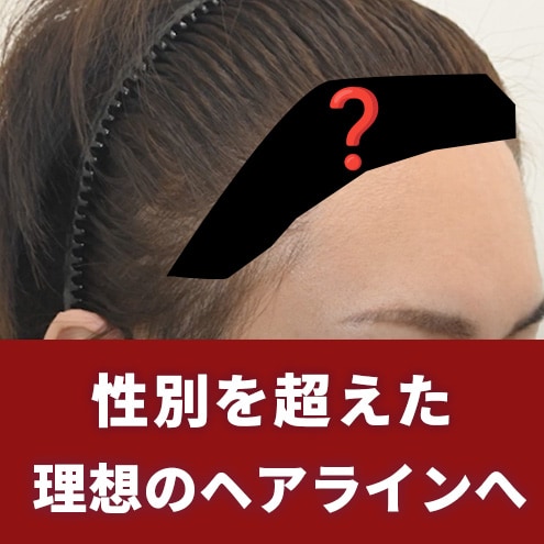 【自毛植毛】男性でも女性のようなヘアラインはできるのか？