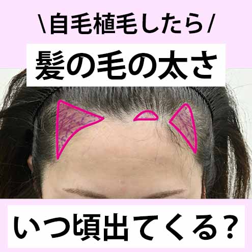 ※自毛植毛 症例写真あり　髪の毛の太さはいつ頃出てくる？【湘南AGAクリニック広島院】