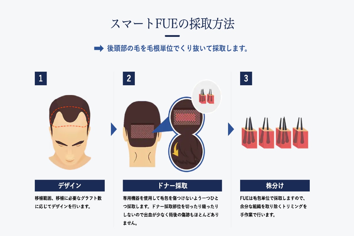 FUE植毛の特徴