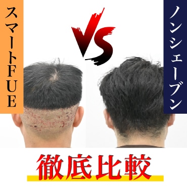 自毛植毛の選択肢:ノンシェーブン植毛 vs FUE徹底比較