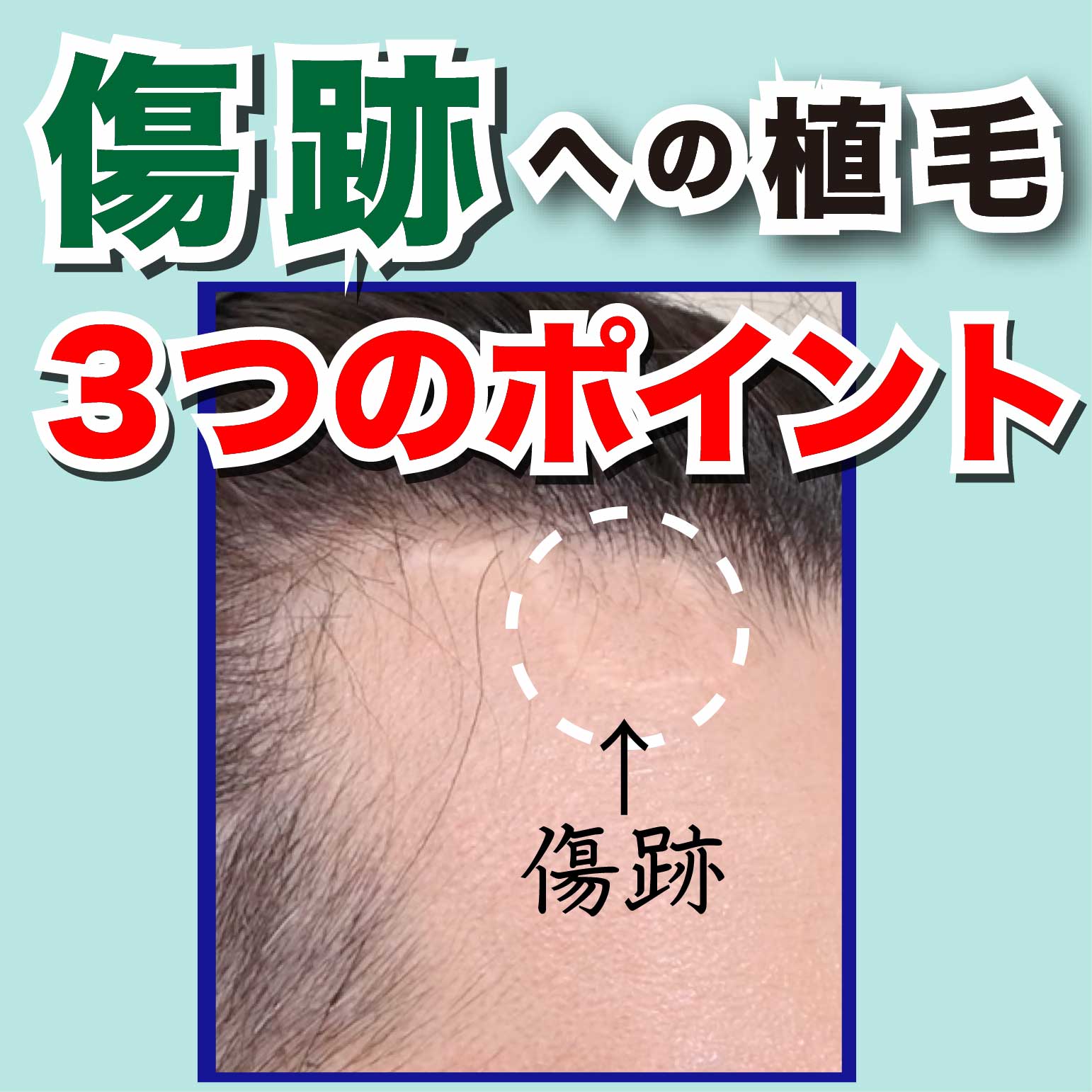 【植毛1年後】傷跡(瘢痕組織)への植毛は成功したのか?ポイントと最終結果を徹底公開!
