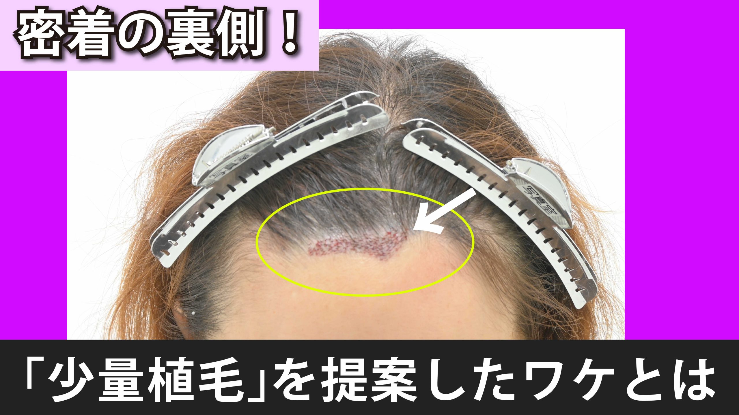 【特集】なぜ医師は「あえて少量の植毛」を提案したのか？
