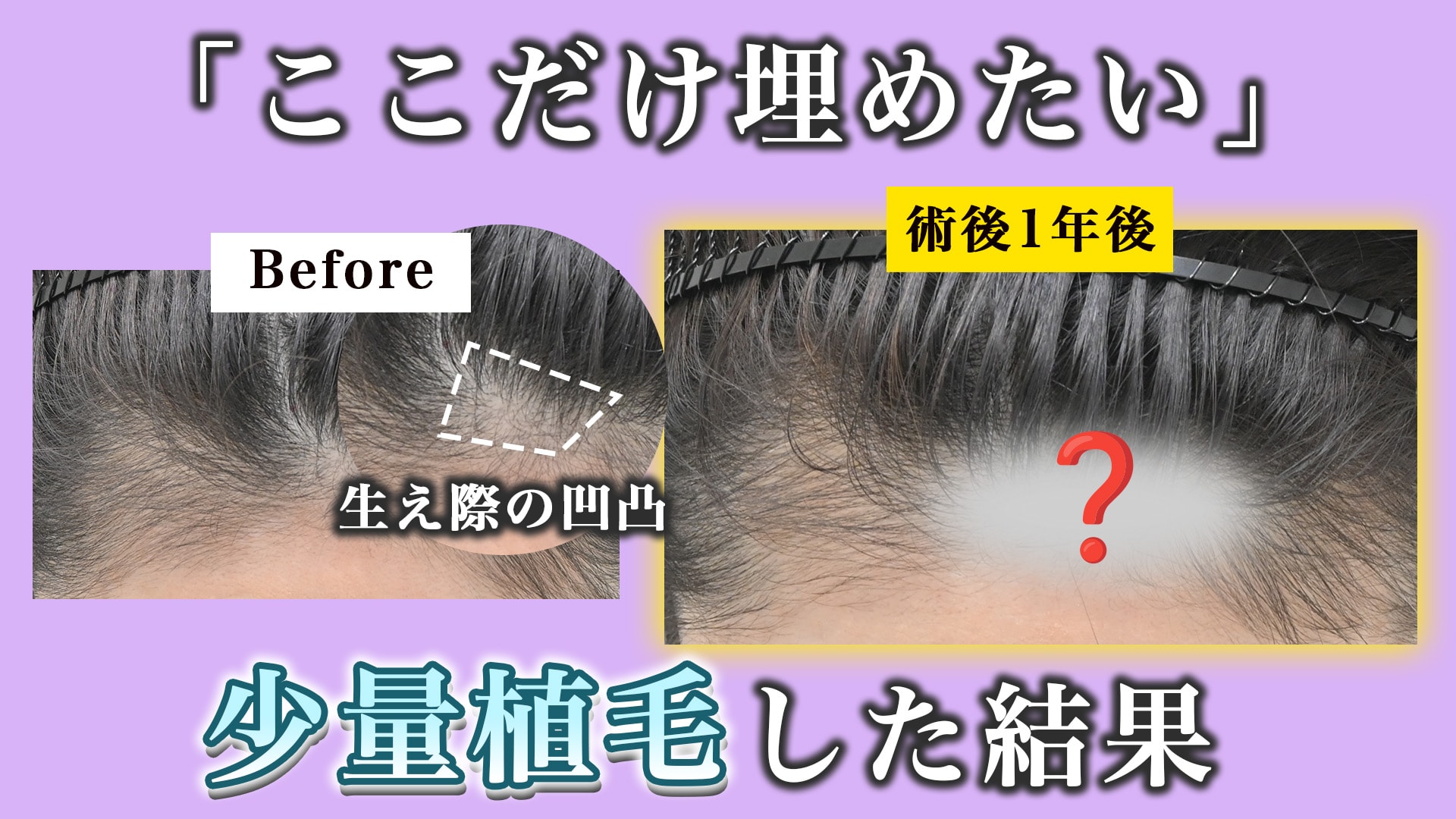 ダウンタイム「ほぼゼロ」？100株の少量植毛で自然なヘアラインを