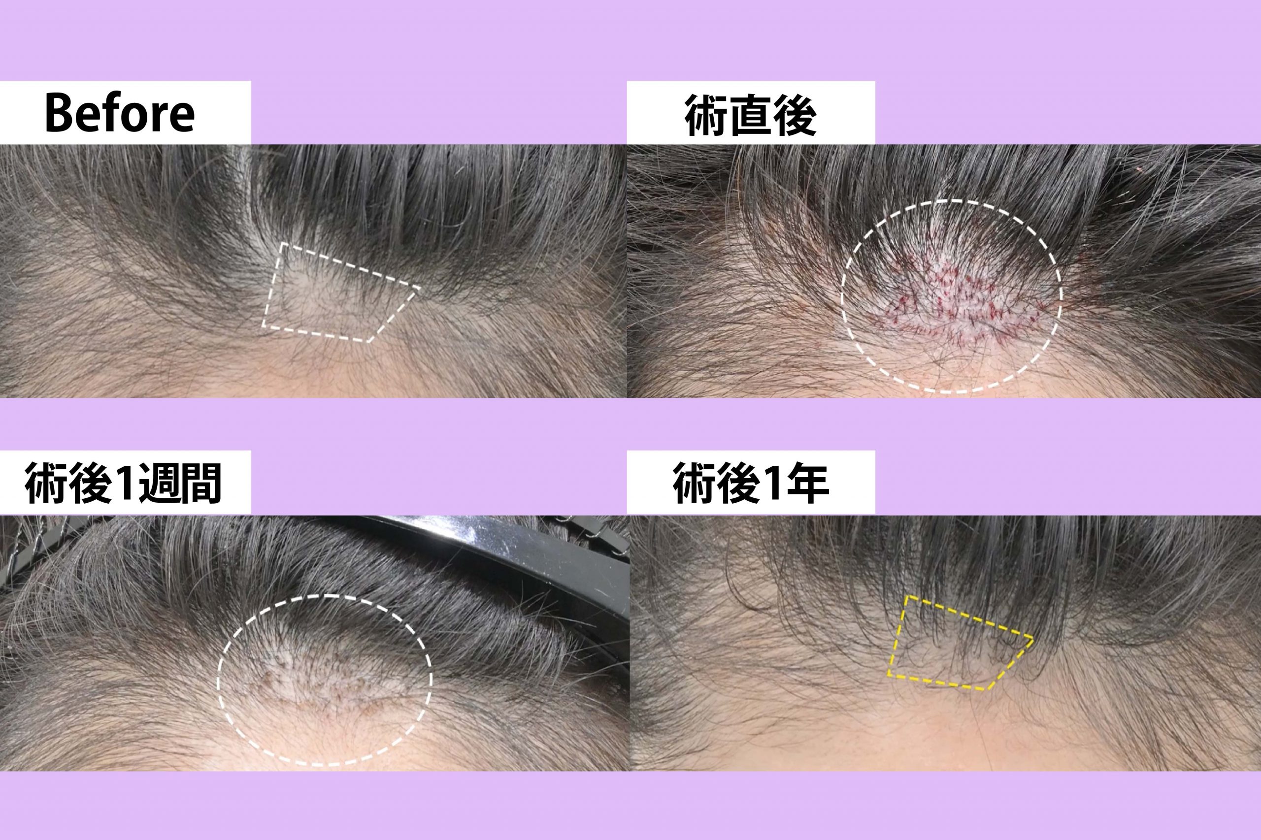 ダウンタイム「ほぼゼロ」？100株の少量植毛で自然なヘアラインを