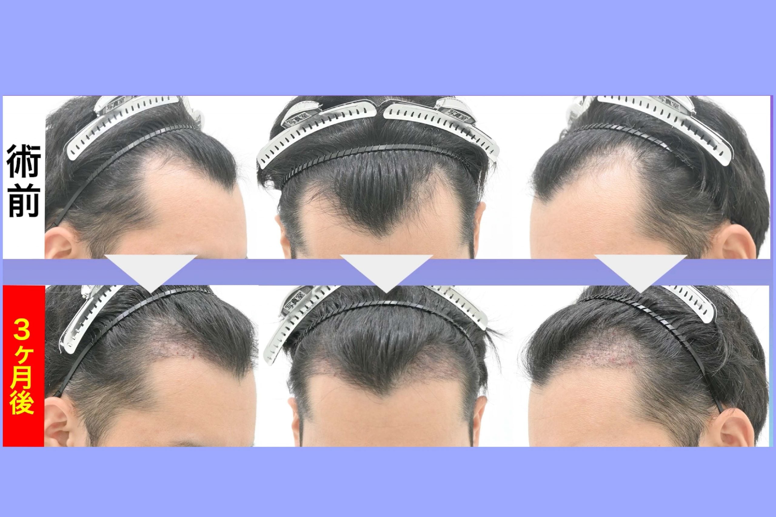 【術後3ヶ月】 髪の毛の「芽生え」の時期と頭皮の回復