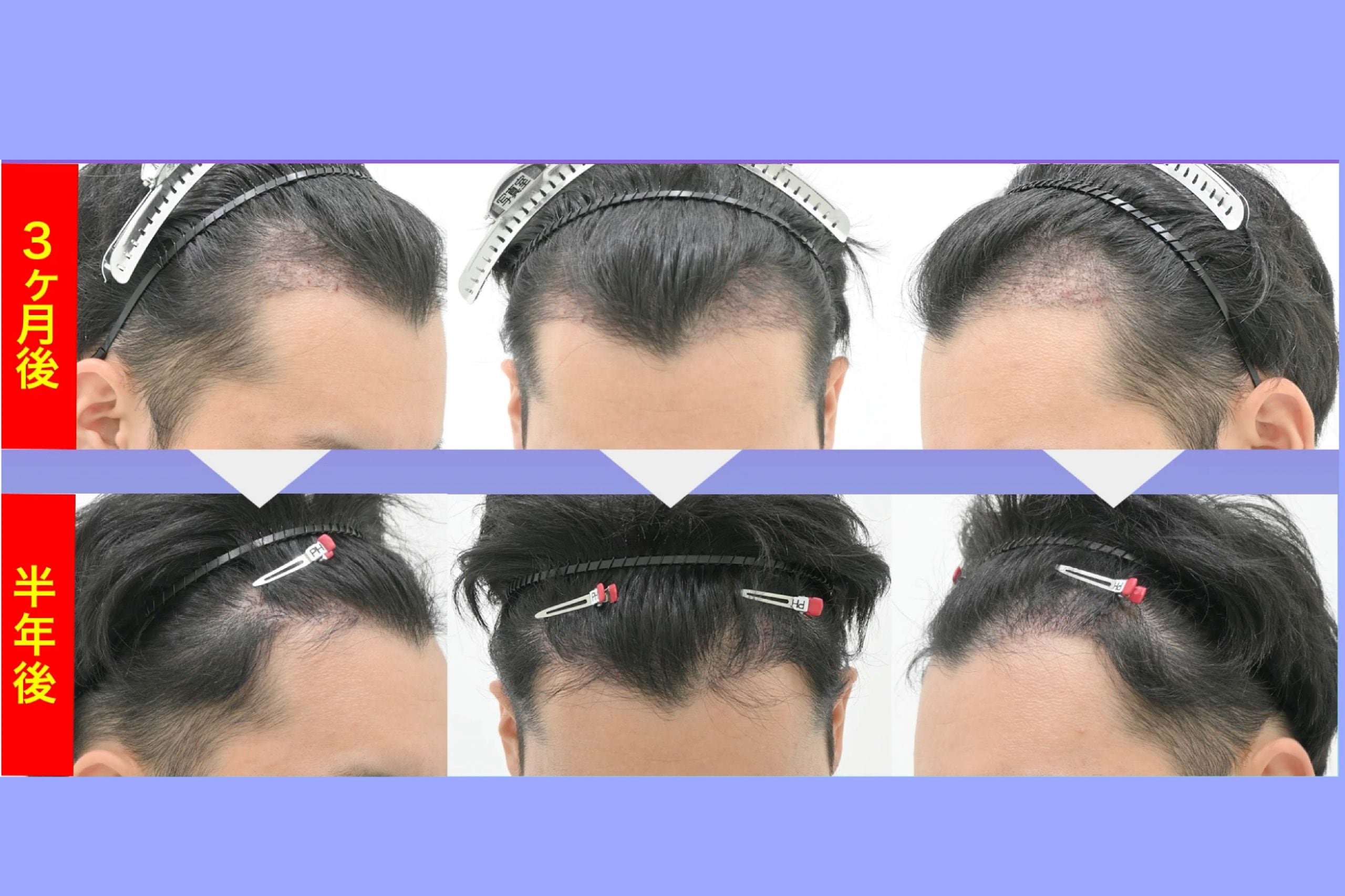 【術後半年（6ヶ月）】 成長の本格化と、左右差への理解