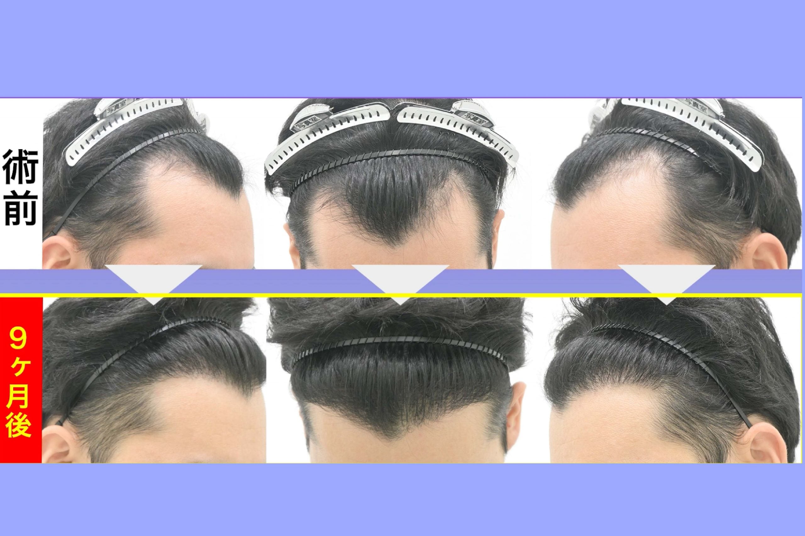 【術後9ヶ月】 ヘアラインの「ほぼ完成形」と今後の展望