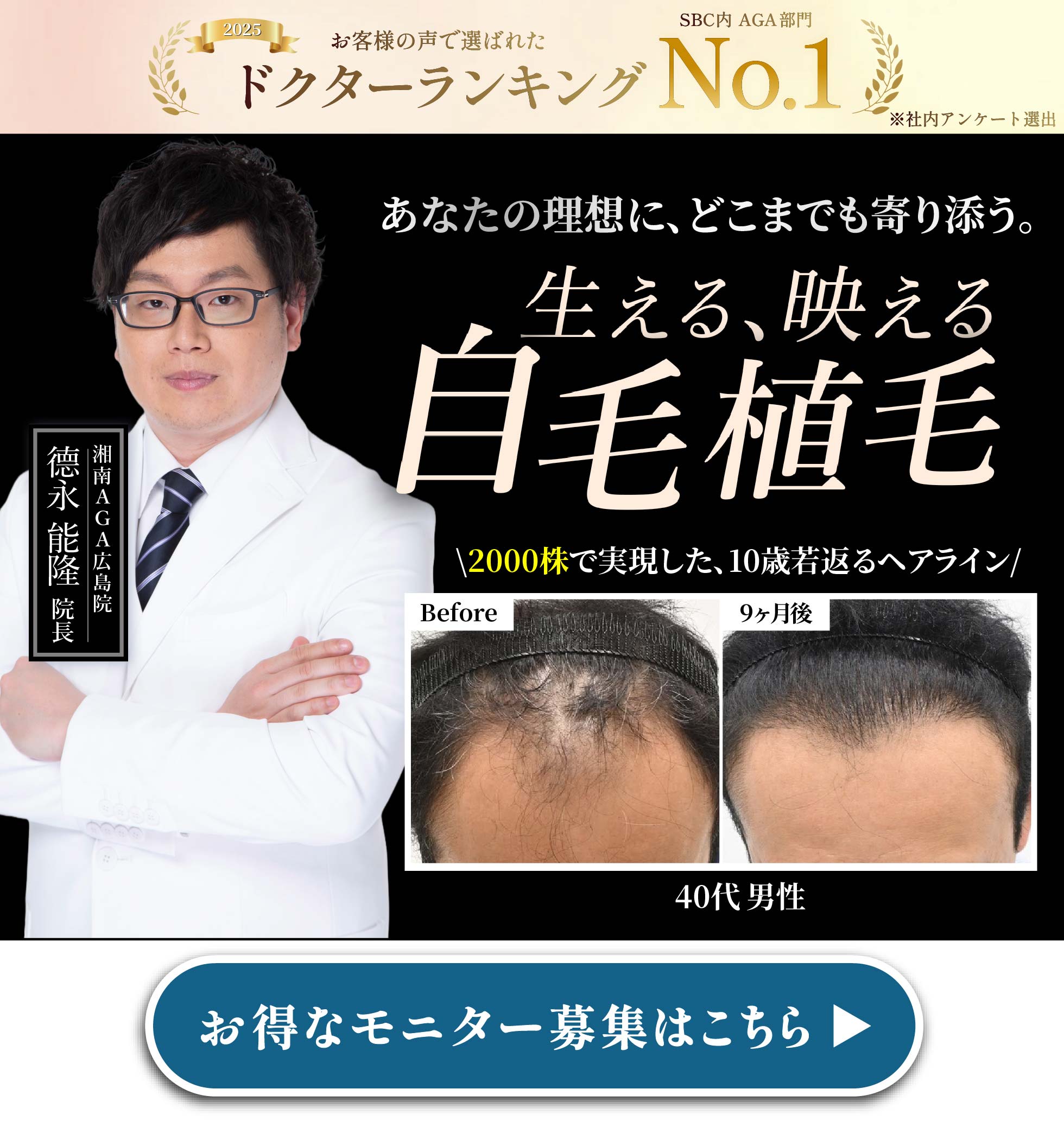 自毛植毛モニター募集