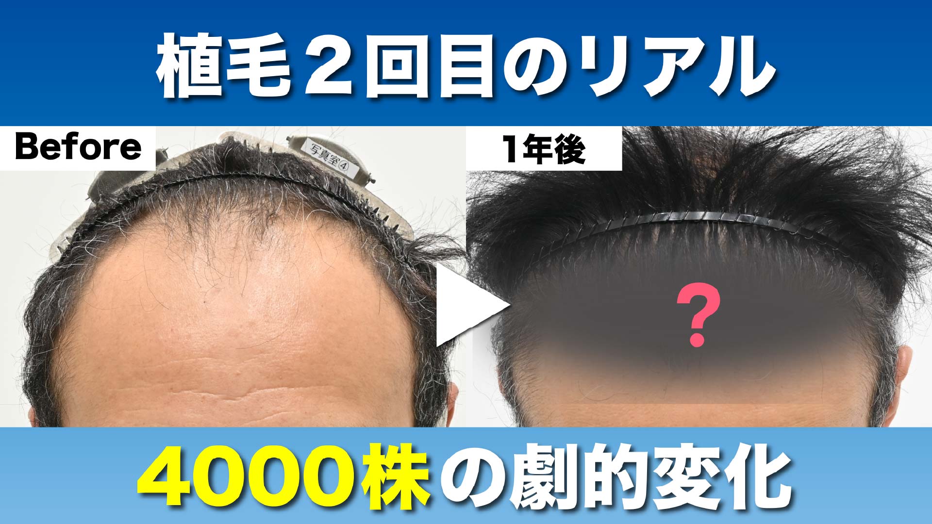 【自毛植毛広島】合計4000グラフトの衝撃！50代男性が「理想の前髪」を取り戻した軌跡