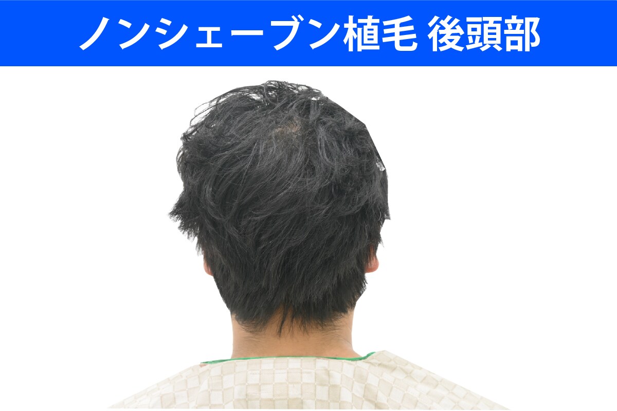 周囲に絶対にバレたくない方のための「ノンシェーブン」